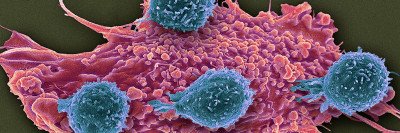 Scanning electron micrograph (SEM) of T lymphocyte cells (blue) attached to a red cancer cell.