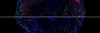 Confocal microscopic image of mouse lymphedema tissue with staining for immune cells and lymphatic vessels.