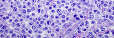 Microscopic image of lymphoma cells stained purple.
