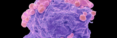 Colored scanning electron micrograph of a lymphoma cell showing early apoptotic changes