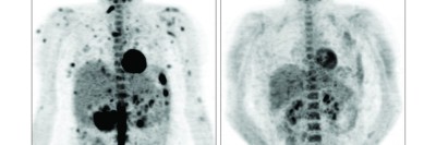 Two images of a human torso show a reduction in tumors after treatment with targeted therapy.