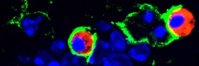 Mouse glioblastoma tumor with phagocytic macrophages