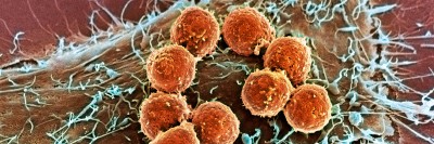 Pictured: Immune system cells called T cells (orange) have detected a cancer cell and attached to it. Innovative drugs pioneered by Memorial Sloan Kettering researchers stimulate the ability of T cells to recognize and destroy cancer cells.