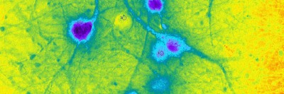 Pictured: Nerve cells generated from embryonic stem cells and manipulated by a technology called optogenetics. Memorial Sloan Kettering scientists are using stem-cell engineering to develop new treatments for Parkinson’s disease.