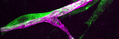 Pictured: A metastatic breast cancer cell (green) has infiltrated the brain and is holding on tightly to a blood capillary (purple).