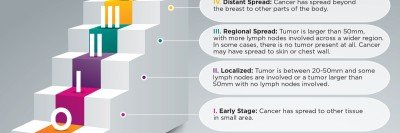 Infographic describing the 5 stages of breast cancer: stage 0, stage 1 (early stage), stage 2 (localized), stage 3 (regional spread), stage 4 (distant spread).