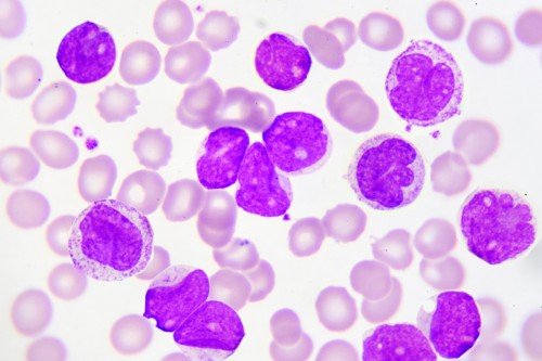 Acute myeloid leukemia cells under a microscope