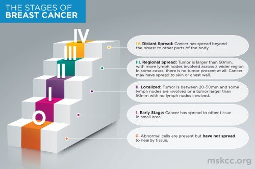 Infographic describing the 5 stages of breast cancer: stage 0, stage 1 (early stage), stage 2 (localized), stage 3 (regional spread), stage 4 (distant spread).