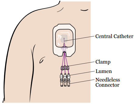 Cvc Hospital וועגן אייער צענטראלע ווענוס קאטעטער (Central Venous Catheter, CVC) פאר ...
