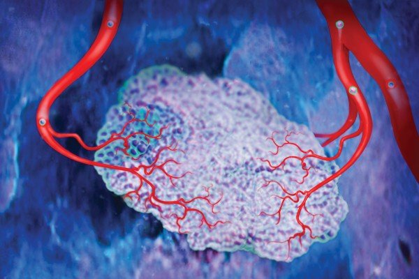 tumor in microenvironment