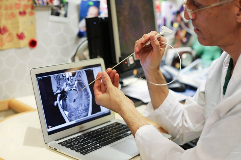 Review Our Experience with Convection Enhanced Delivery for Diffuse